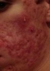 acne 1.jpg acne 1.jpg