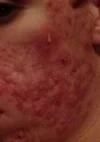 acne 1.webp acne 1.webp