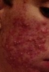 acne 2.jpg acne 2.jpg