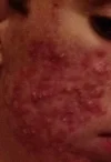 acne 2.webp acne 2.webp