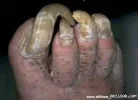 gross_feet.webp